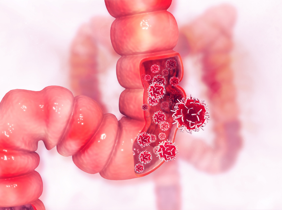 Kolon Kanseri Paneli